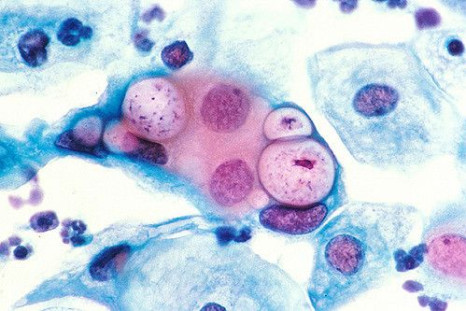 By acquiring genetic mutations, Chlamydia trachomatis, which causes the sexually transmitted infection, can transform into a strain causing blindness.
