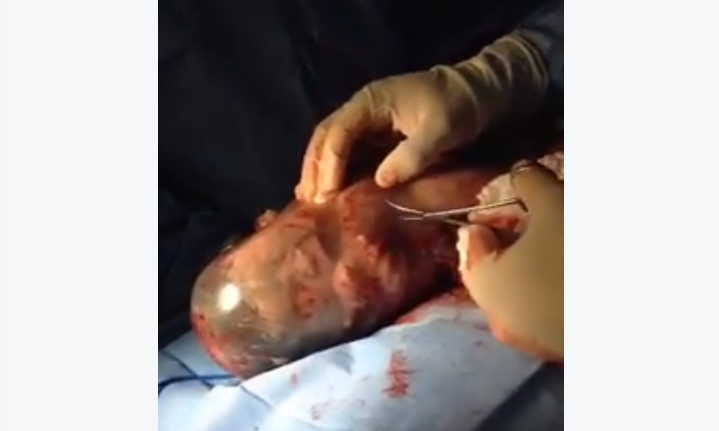 En Caul Birth