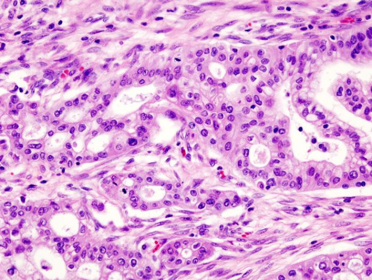 Pancreatic ductal adenocarcinoma