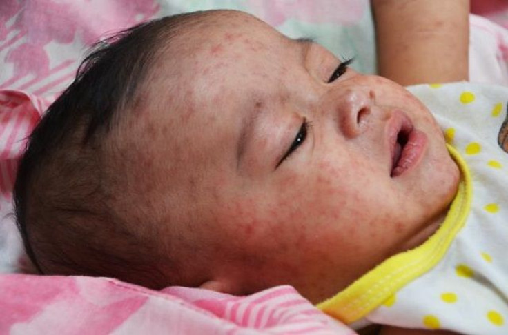 Child with measles