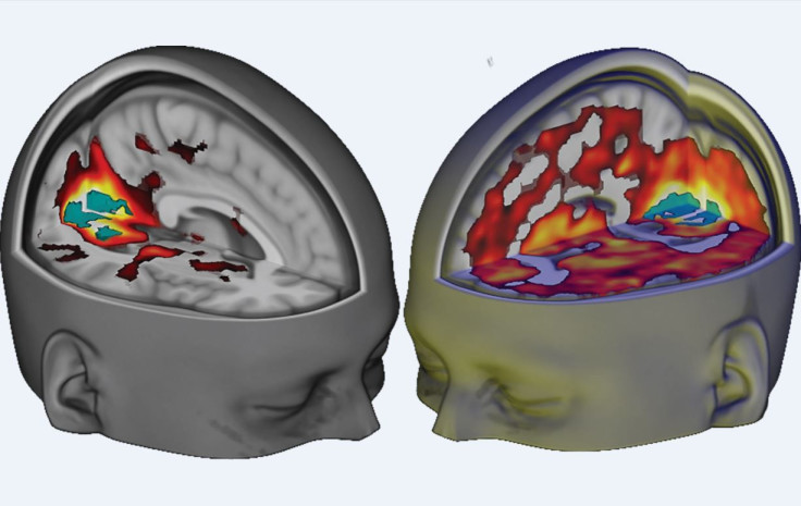 Brain on LSD