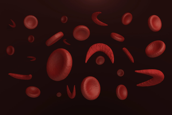 sickle cell