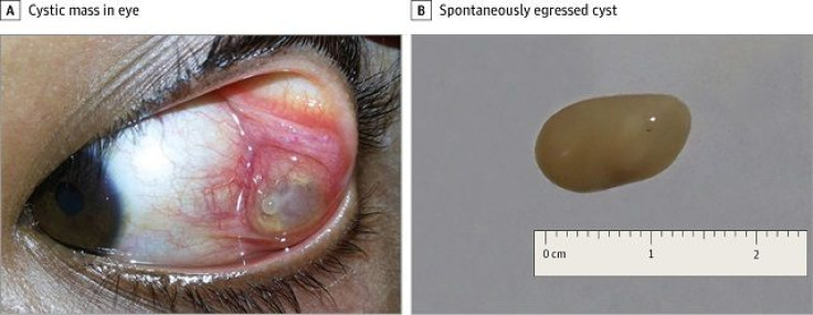 Tapeworm cyst