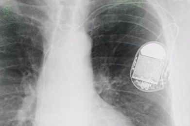 The pacemaker was a result of medical accident.