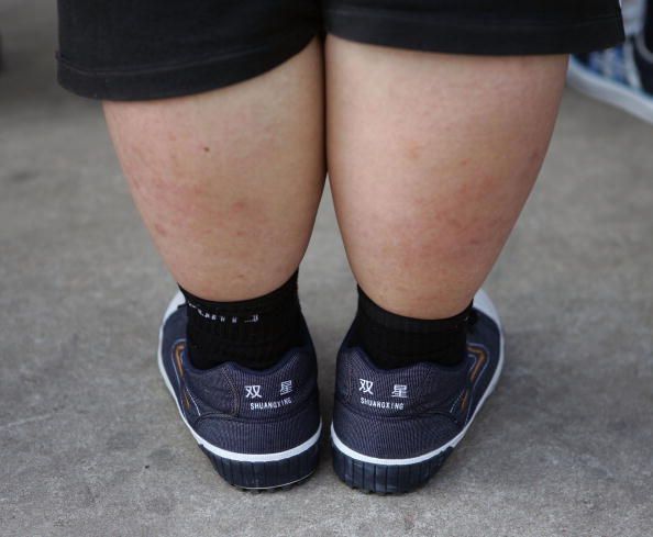 Obese Boys Are At Increased Risk Of Infertility In Adulthood, Study Says