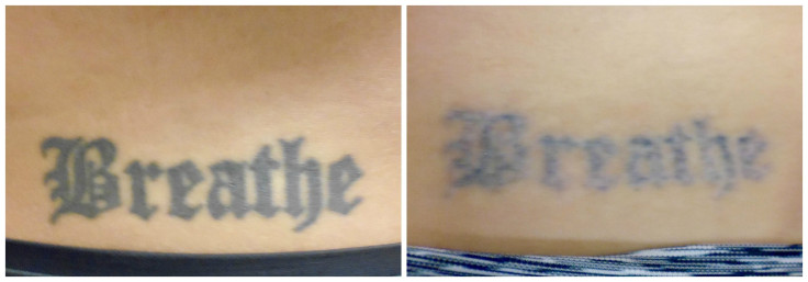 Tattoo Removal Before and After