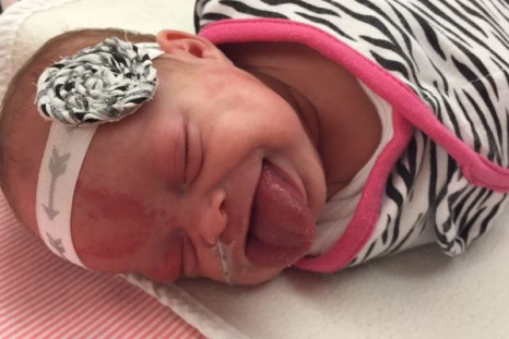 Baby Paisley was born with an oversized tongue, but has since had its size reduced surgically.