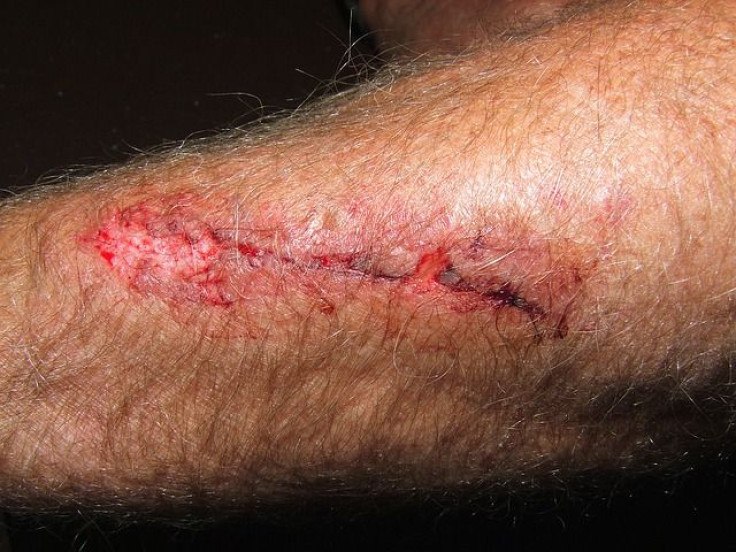 Arm wound