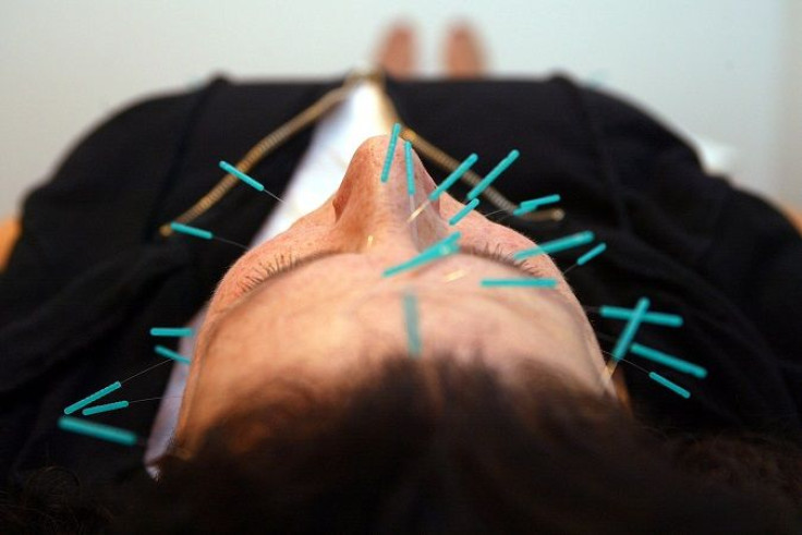 accupuncture