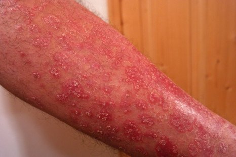 Plaque psoriasis can be itchy and painful.