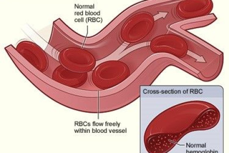 Red blood cells are not flexible in people with sickle cell anemia.