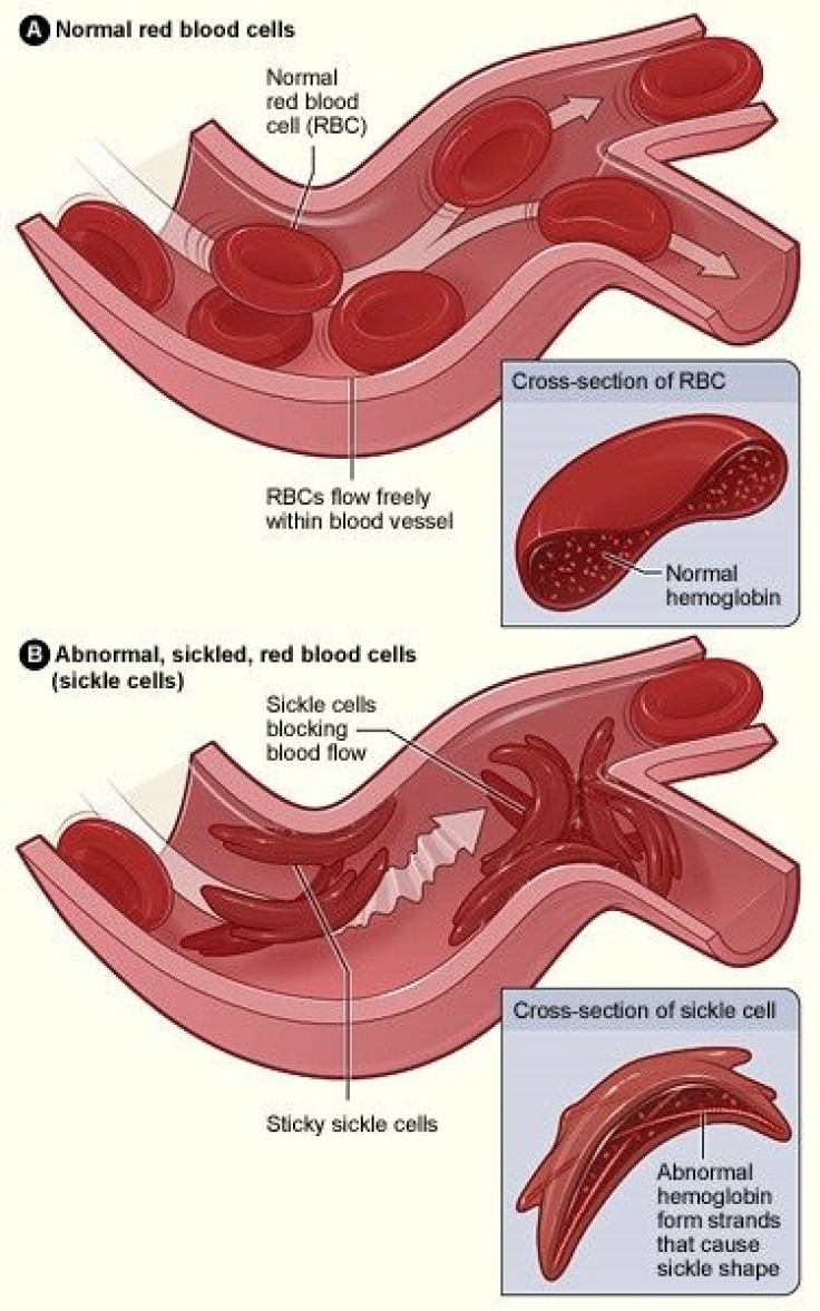 anemia-cell