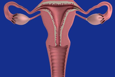 In post-menopausal women, an ovarian cyst can increase risk of ovarian cancer.