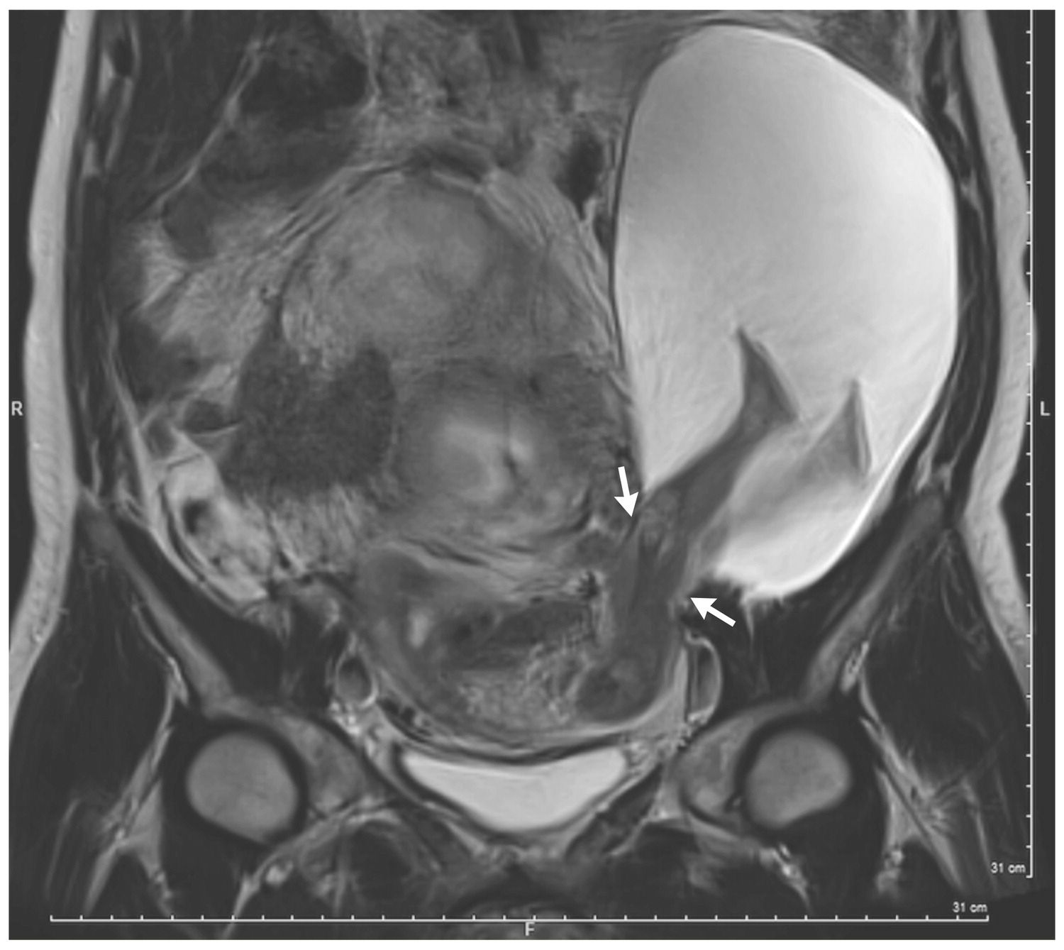 baby-s-legs-rip-through-mother-s-womb-after-5-c-sections-weaken-uterus-wall