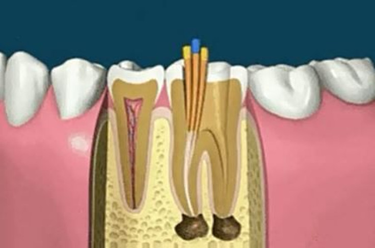 root-canal