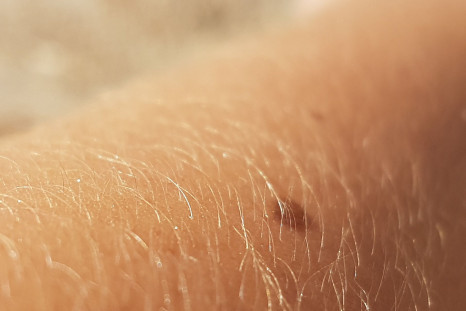 Melanomas can grow anywhere on the body that has skin.