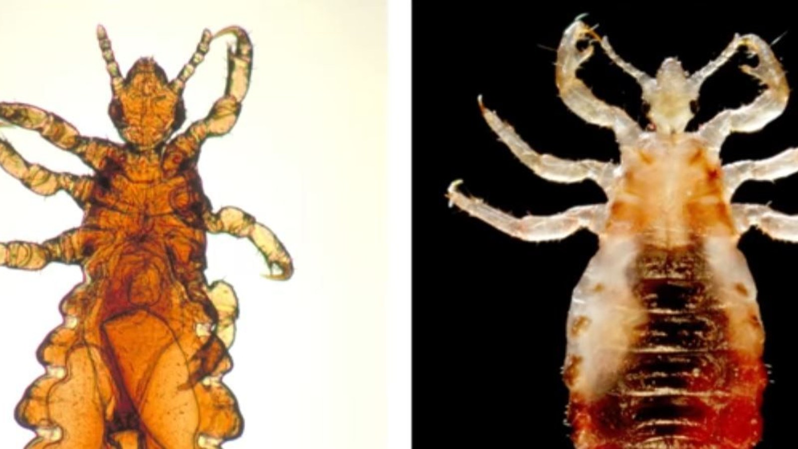 Body Lice Vs Head Lice