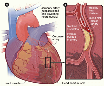 Figure A is an overview of a heart and coronary artery showing damage (dead heart muscle) caused by a heart attack. Figure B is a cross-section of the coronary artery with plaque buildup and a blood clot.