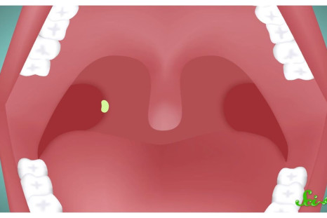 Tonsil stones can be annoying, but they're not dangerous.