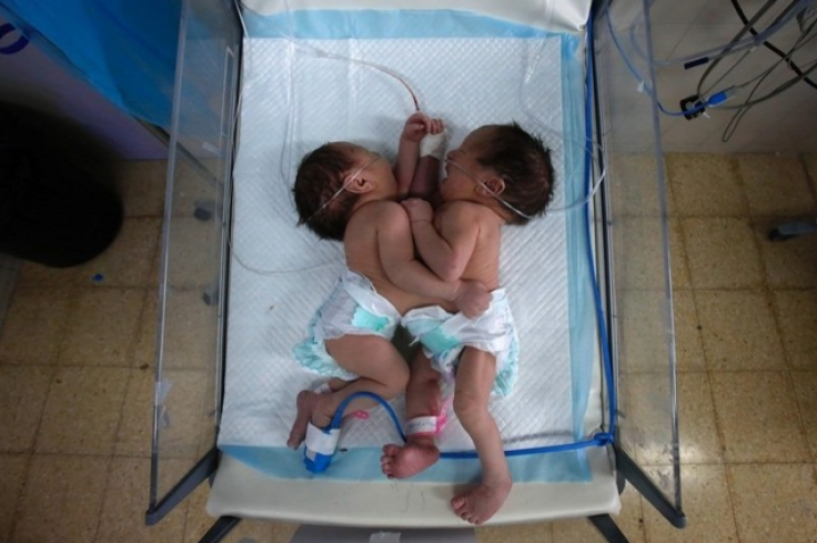 Conjoined Twins West Bank