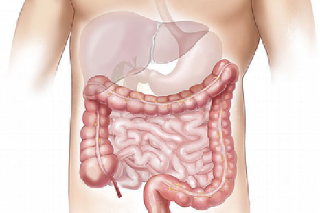Celiac disease is a digestive disorder that affects the small intestine.