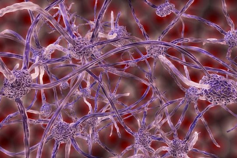 Multiple sclerosis affects the nerve cells, and causes them to lose their protective coating.