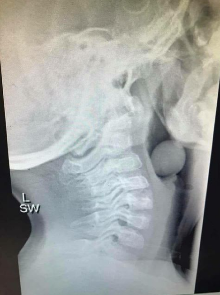 grape in throat xray