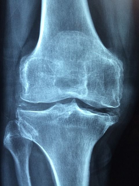 Noisy Knees That Crack And Pop Could Be An Early Sign Of Osteoarthritis