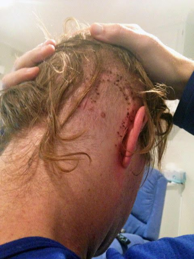 Doug Wilson scar