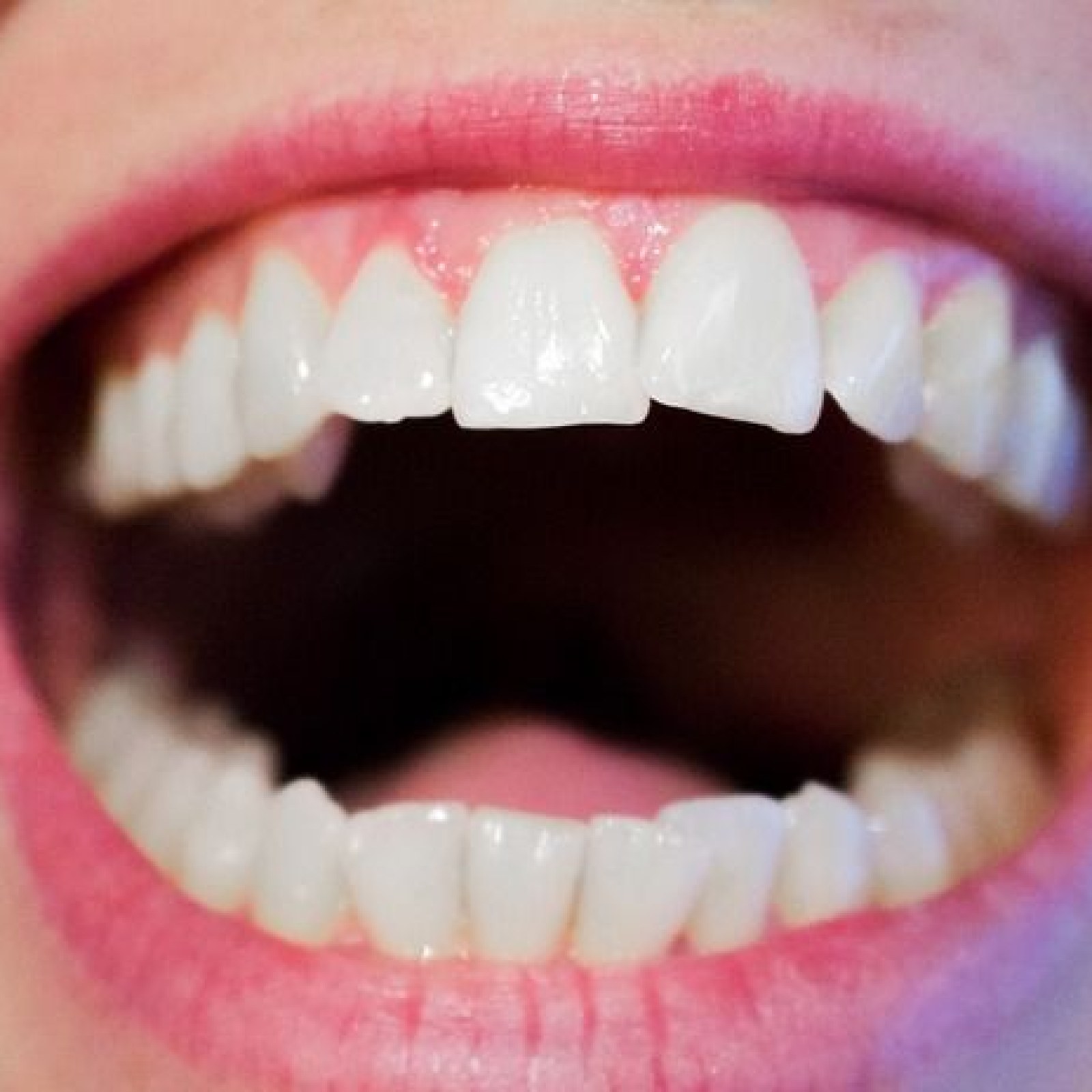 bpc 157 receding gums Why You Need to Offer Dental Fillers for BPC-157: The Body Protection Compound