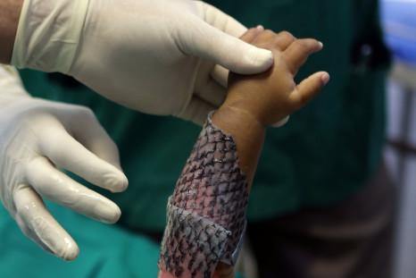 The tilapia skin is left on the patients until their own skin begins to scar over.