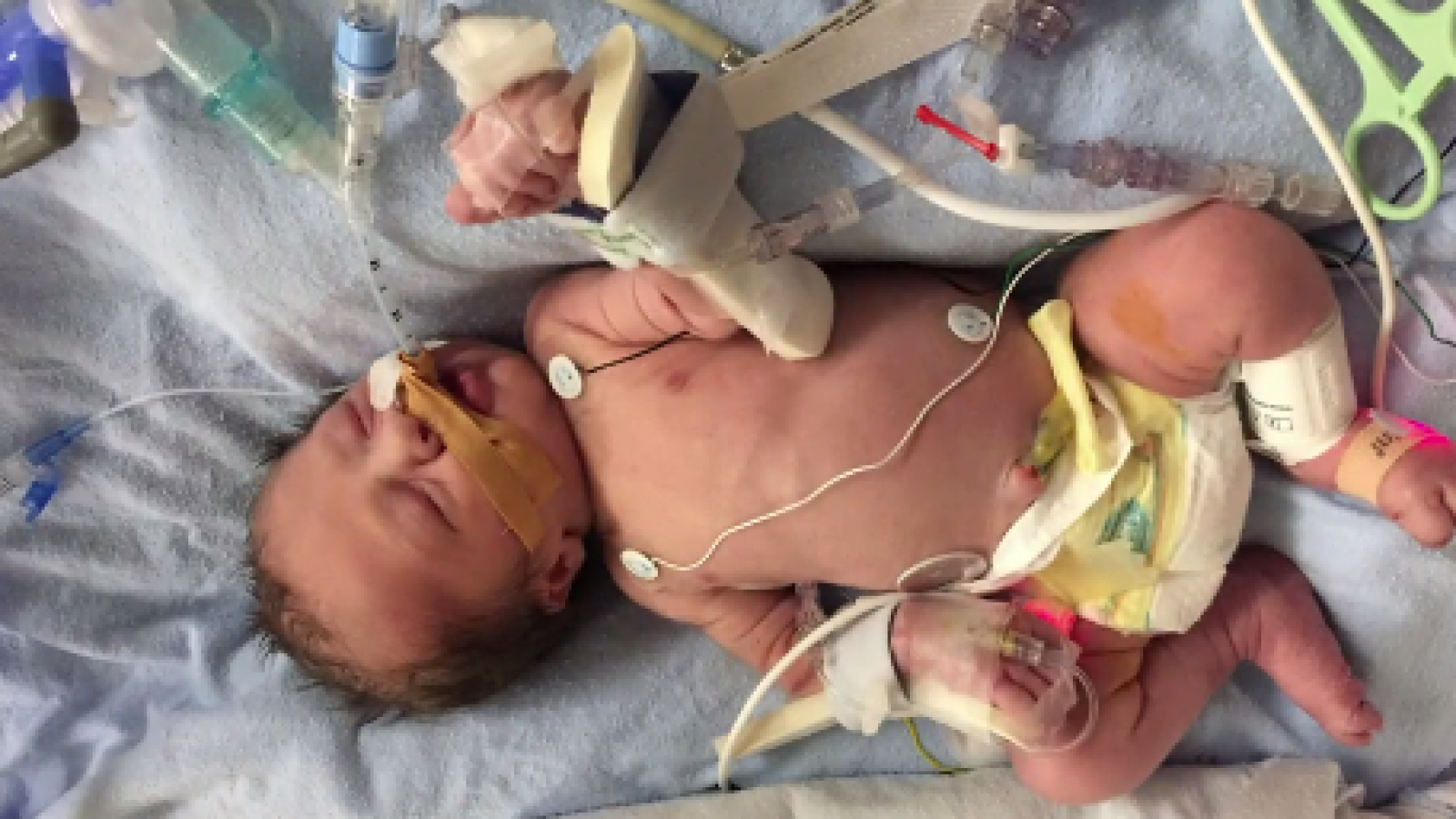 Unborn Baby With Heart Defects Undergoes Life-Saving Procedure For Better Blood Flow