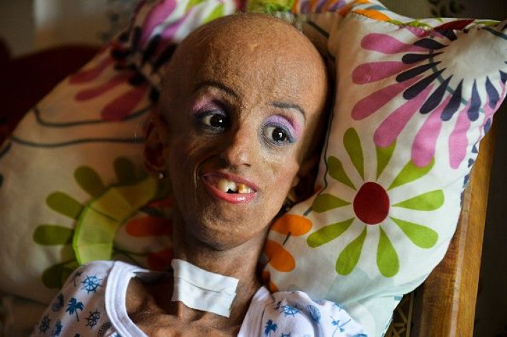 progeria