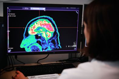 A picture of a human brain taken by a positron emission tomography scanner, also called PET scan, is seen on a screen on January 9, 2019, at the Regional and University Hospital Center of Brest, western France.