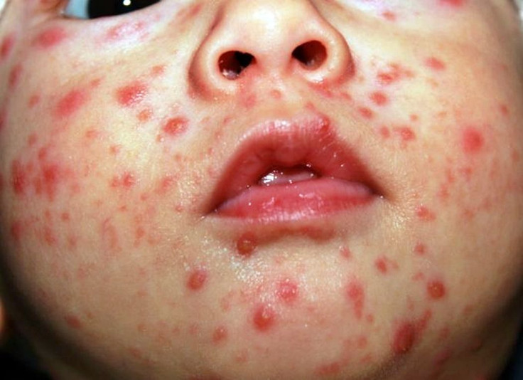 Baby with chicken pox