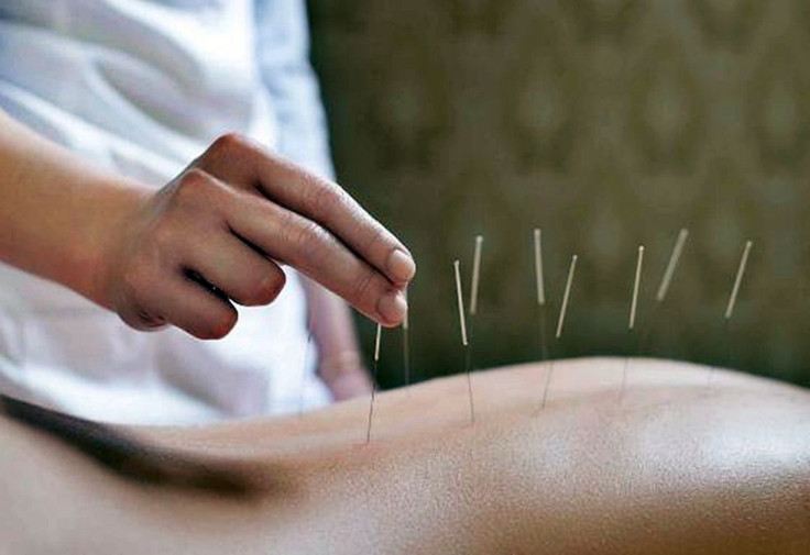 Acupuncture