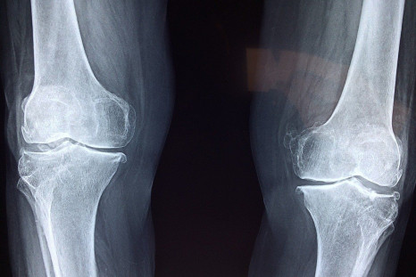 Osteoarthritis is the most common form of arthritis, commonly affecting the hands, hips and knees.