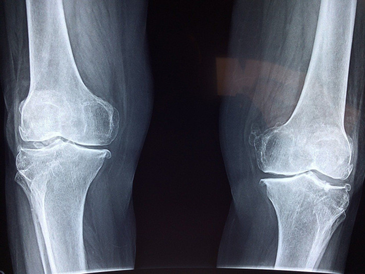 Osteoarthritis