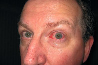 A registered nurse at the Life Care Center in Kirkland, Washington, said that some patients did not exhibit the most common symptoms of COVID-19, such as fever, tiredness and dry cough, but they all appeared with redness around the eyes.