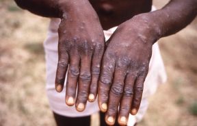 How To Protect Yourself Against Monkeypox Amid Global Outbreak