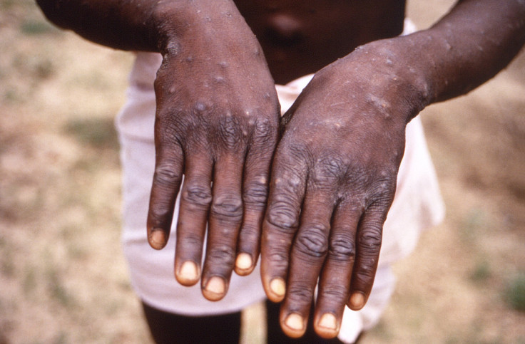 How To Protect Yourself Against Monkeypox Amid Global Outbreak