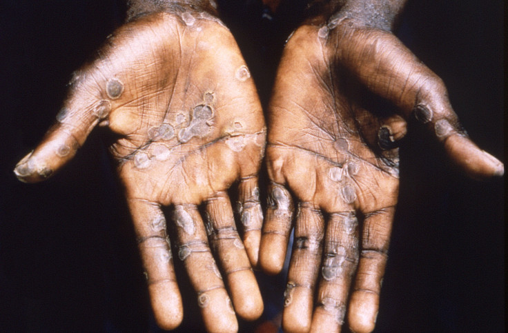 Monkeypox: Is It Airborne And Can Masks Prevent The Spread?