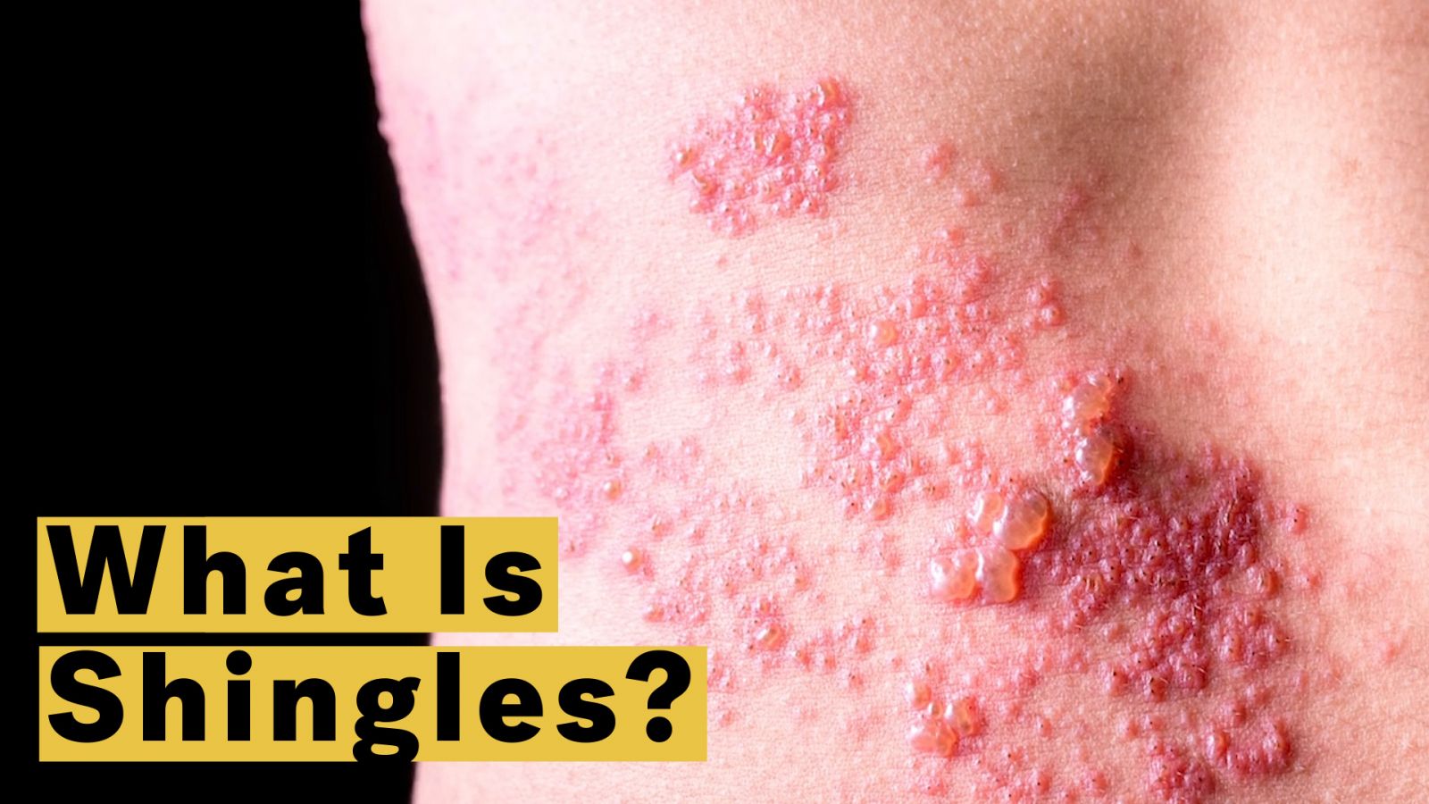 semaglutide and shingles The Covid-19 Vaccine Won't Give You Herpes. Here's Why Should I Get the Shingles