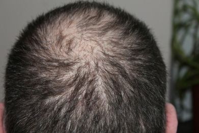 Some people recovering from COVID-19 are experiencing hair loss.
