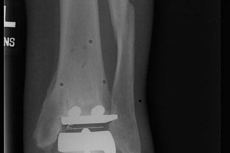 X-ray of a patient with a Scandinavian Total Ankle Replacement implanted.