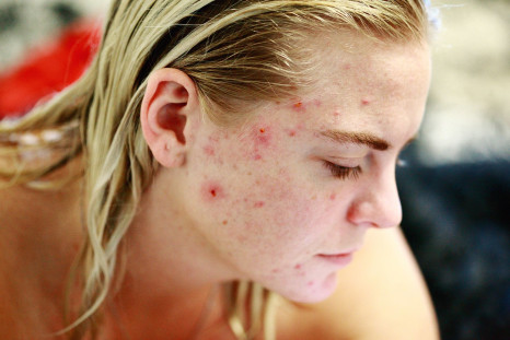 Acne can be persistent.