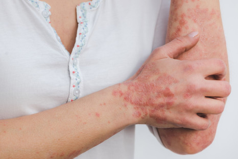Psoriasis may appear as flaky patches on the skin.