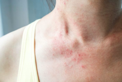 Here's everything you need to know about eczema.