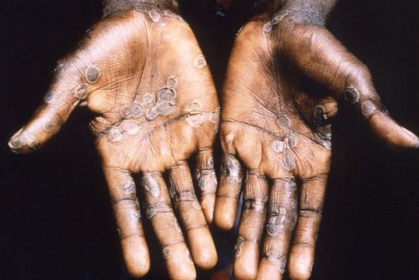 Close-up of a patient's hands, on black background, showing lesions from the monkeypox virus, the Democratic Republic of the Congo, 1997. Courtesy CDC/Mahey et al.