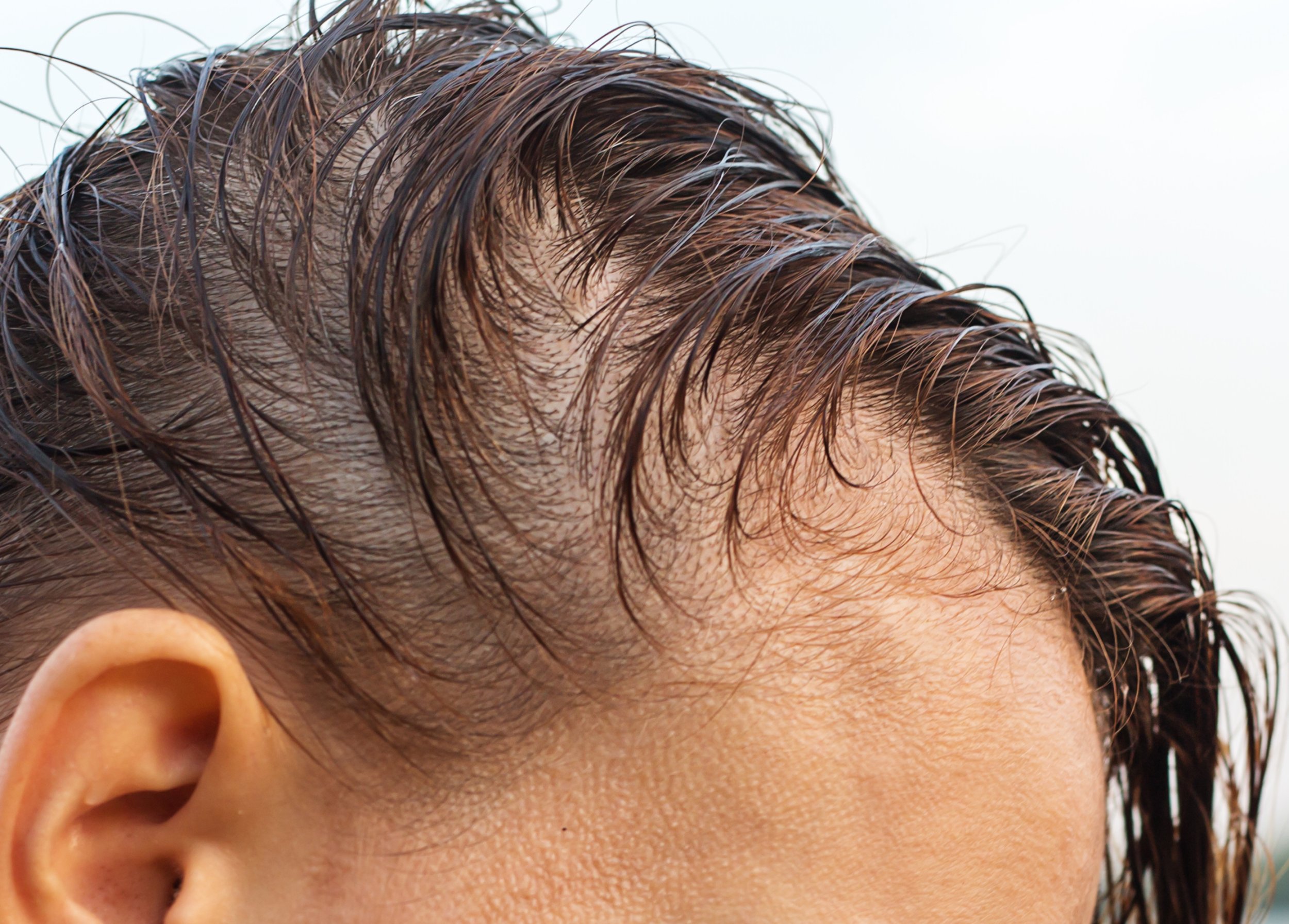 Hair Loss  Dermatology and Skin Health  Dr Mendese
